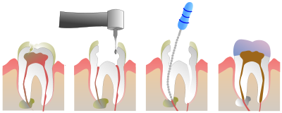 Root Canal Illustration